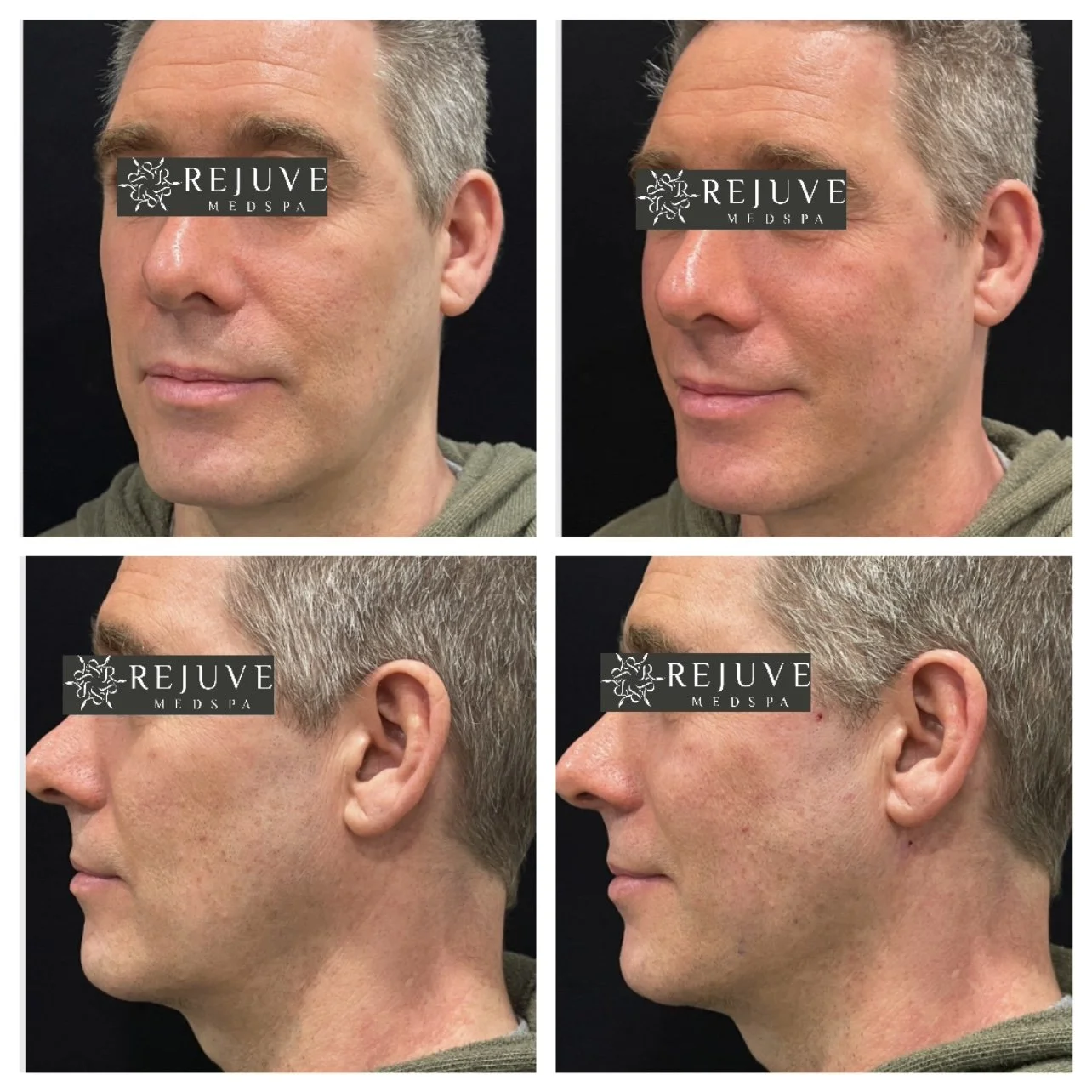 pdo-thread-lift-instant-nonsurgical-facelift-with-threads-rejuve